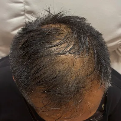 頭頂部 施術前