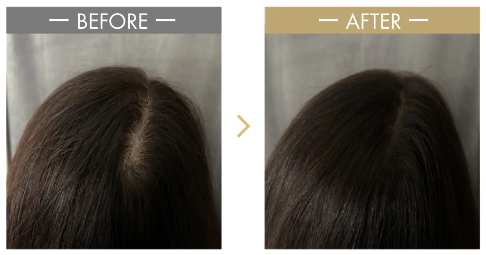 分け目の透け感が気になる頭頂部のビフォーと、ヘアタトゥー施術後のアフター