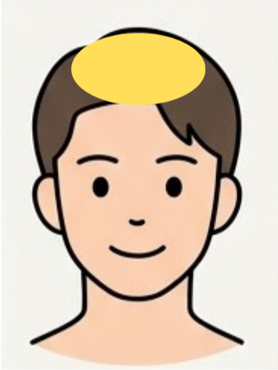 頭頂部の施術範囲イメージ